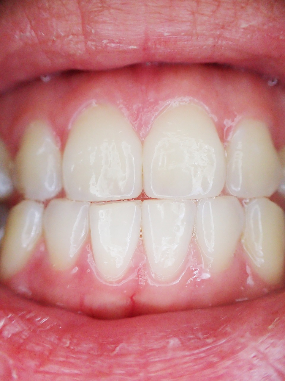 Wybielanie zębów – co powinieneś wiedzieć?